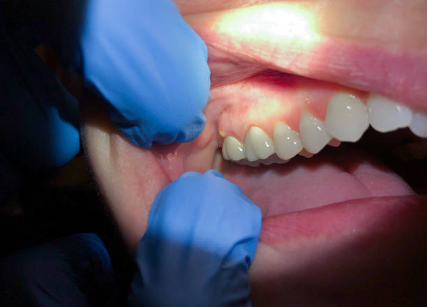 Best Emergency Dentist for Knocked-Out Tooth in Hondo, TX